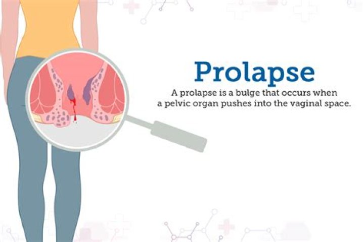 Could i have a prolapse?