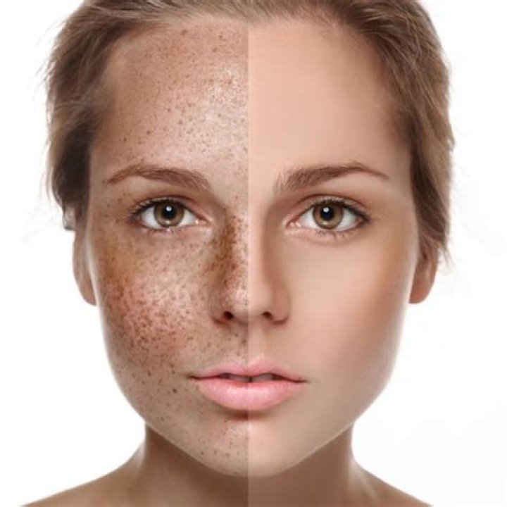 Do sun spots go away?
