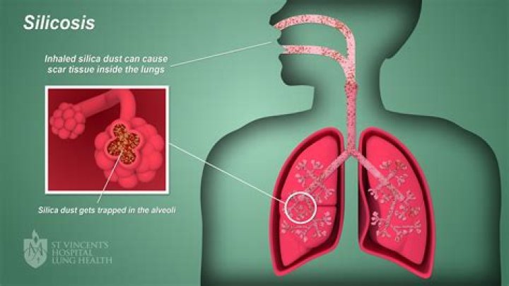 Does silicosis cause tiredness?