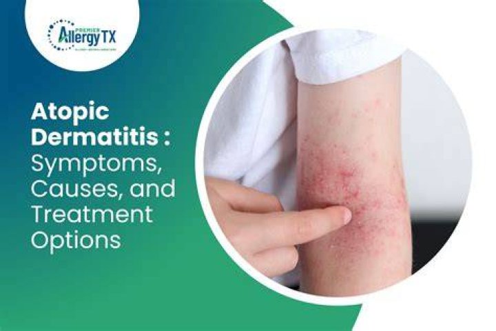 Does sugar cause atopic dermatitis?