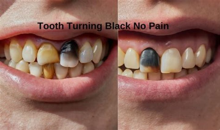 When plaque turns black?